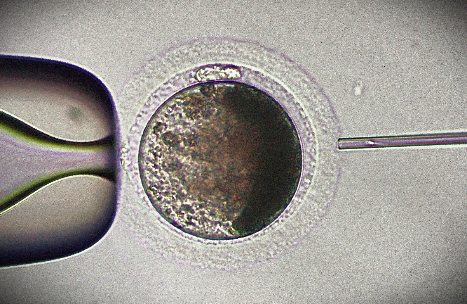 Intracytoplasmic Sperm Injection (ICSI) at Vita Nova Reproduction Center