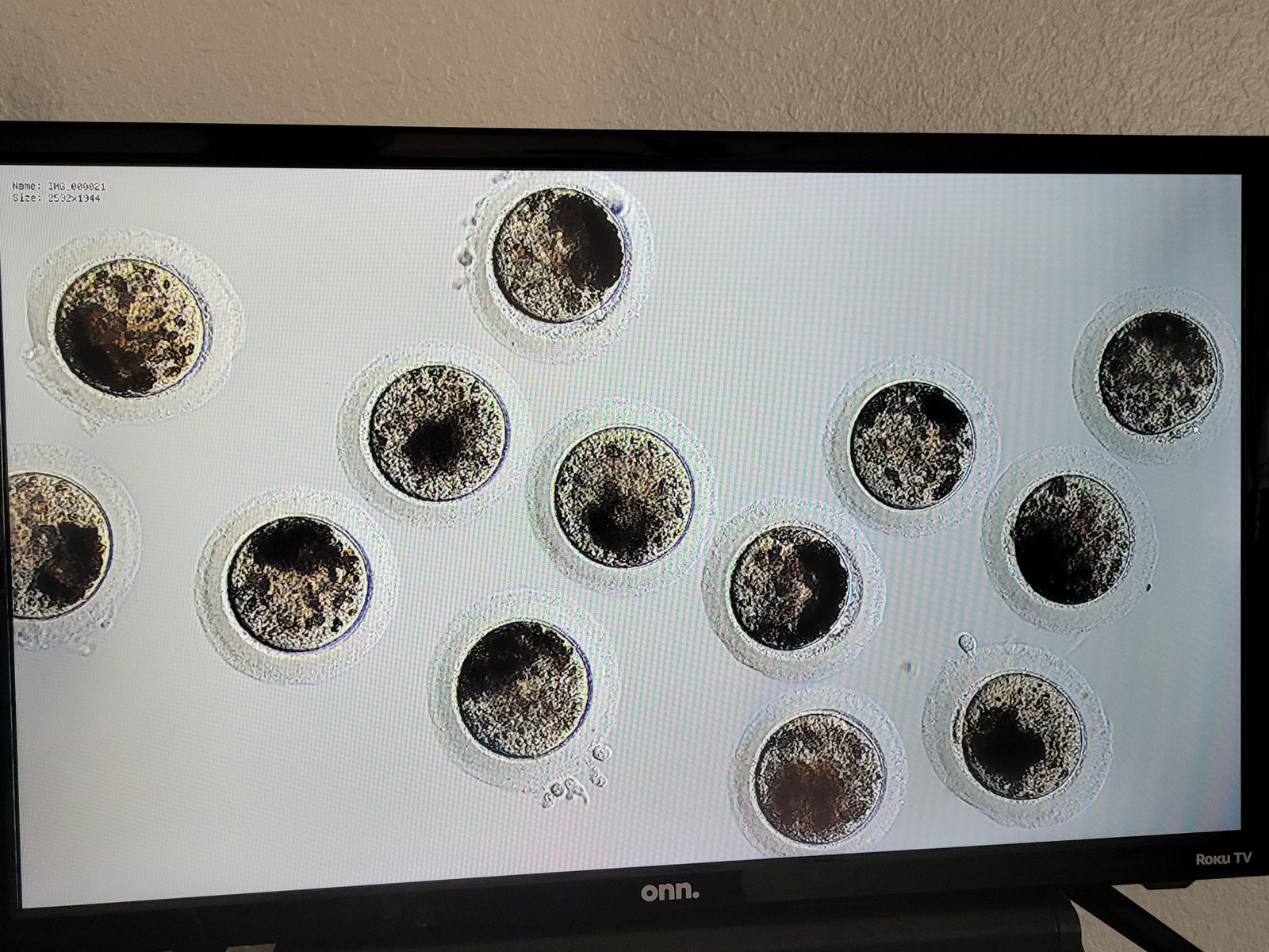 Mature Oocytes ready for ICSI